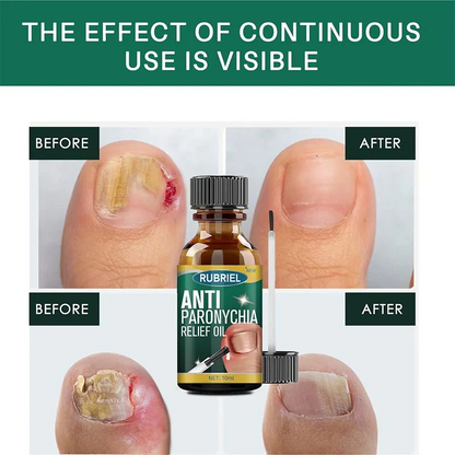 Anti Paronychia Relief Oil - Buy 1 Get 1 FREE🔥